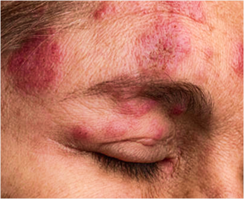 ¿Estás en riesgo de contraer Herpes zóster?