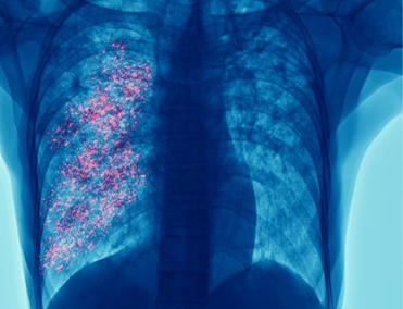 ¿Estás en riesgo de contraer Herpes zóster?